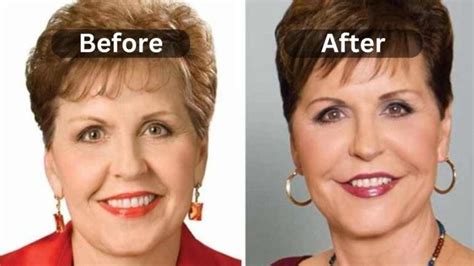 Did Joyce Meyer Have Plastic Surgery: Exploring the Intersection of Faith and Personal Choices